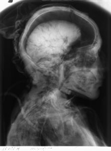 Røntgenbillede af Tollundmanden. Det ses tydeligt at hans hjerne er velbevaret.
